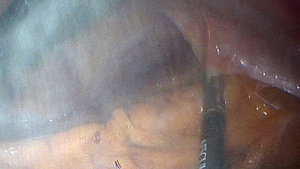 EinsteinVision® bij laparoscopische chirurgie met rookreductie