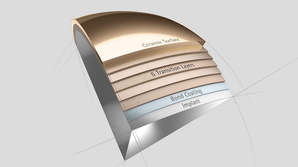 Implants de genou avec revêtement de surface multicouche pour les patients allergiques 