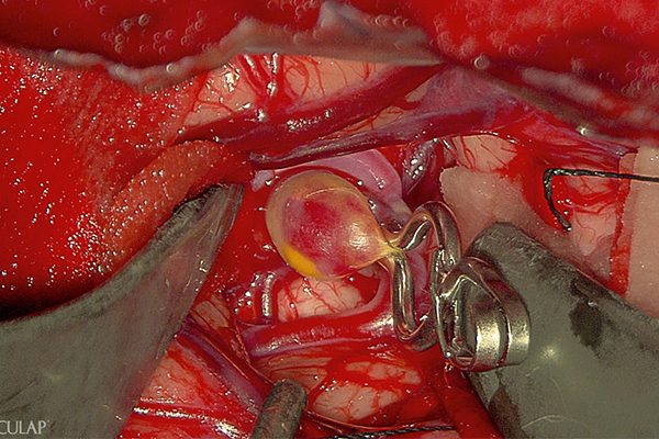 Aesculap Aeos aneurysma witlicht